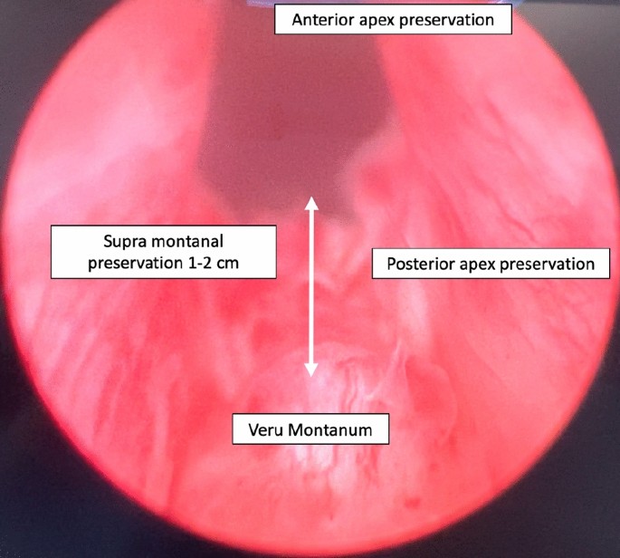 Vista endoscópica das zonas de preservação do ápex prostático